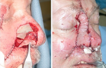 Facial Reconstruction after MOHS Surgery