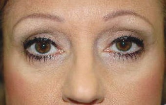 Facial Combination Procedure