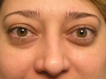 Orbital decompression (thyroid)