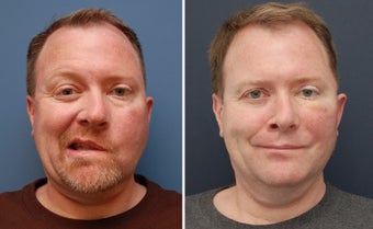Facial Paralysis and Reconstruction