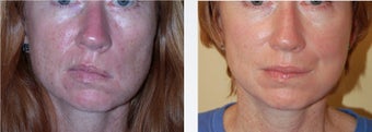Facial Paralysis and Reconstruction