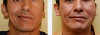 Facial Paralysis and Reconstruction