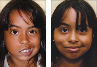 Facial Paralysis and Reconstruction