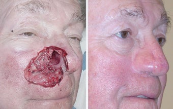 Facial Reconstruction after MOHS Surgery