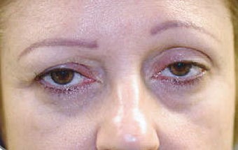 Facial Combination Procedure