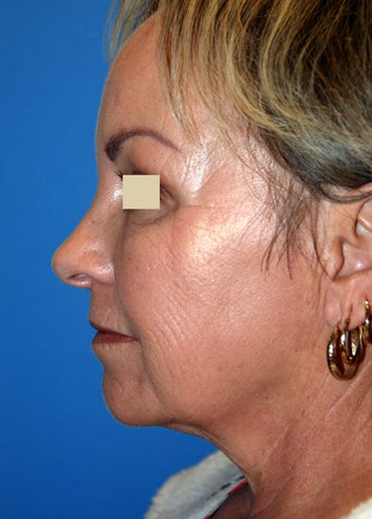 YoungLift ~ Fat Transfer (Full Face)