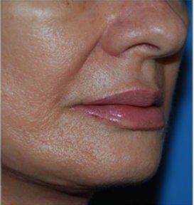 Fat Transfer / Fat Grafting / YoungVolumizer Procedure