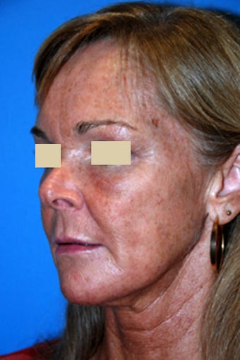 Fat Transfer / Fat Grafting / YoungVolumizer Procedure