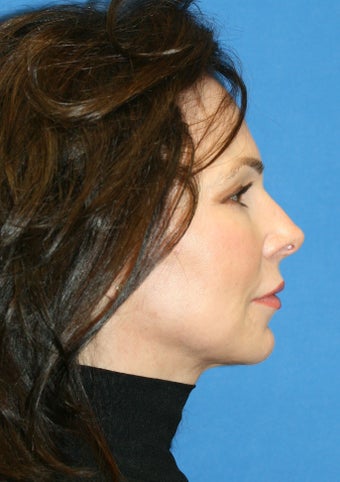 fat transfer