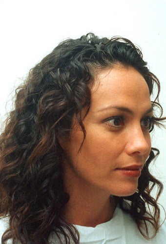 endoscopic brow-lift, upper and lower lid blepharoplasty, septorhinoplasty and lipo transfer to the midface area