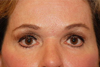 Fat Grafting/Eyelid Surgery