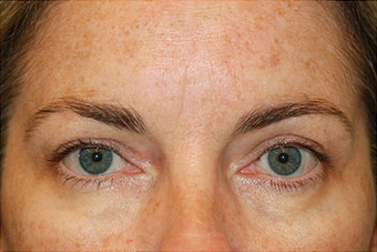 Eyelid Surgery/Fat Transfer