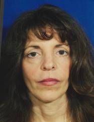 Facial Fat Grafting