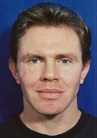 Facial Fat Grafting