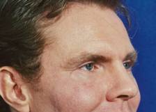 Facial Fat Grafting