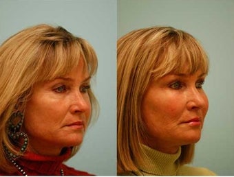Fat Transfer/Fat Grafting/Facial Rejuvenation