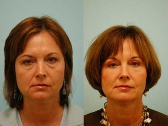 Fat Transfer/Fat Grafting/Facial Rejuvenation