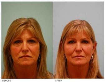 Fat Transfer/Fat Grafting/Facial Rejuvenation