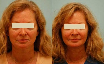 Fat Transfer/Fat Grafting/Facial Rejuvenation