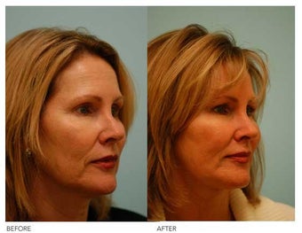 Fat Transfer/Fat Grafting/Facial Rejuvenation