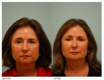 Fat Transfer/Fat Grafting/Facial Rejuvenation