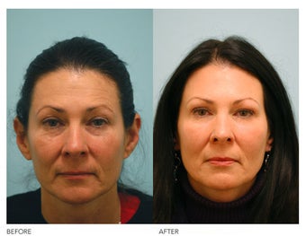Fat Transfer and Facial Rejuvenation