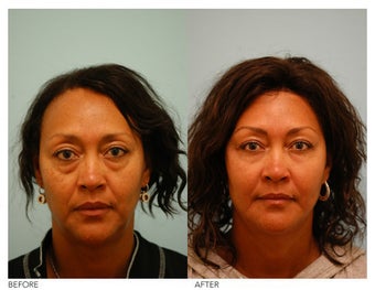 Fat Transfer/Fat Grafting/Facial Rejuvenation