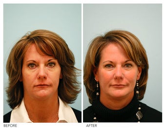 Fat Transfer/Fat Grafting/Facial Rejuvenation