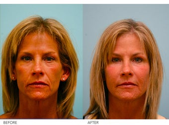 Fat Transfer/Fat Grafting/Facial Rejuvenation