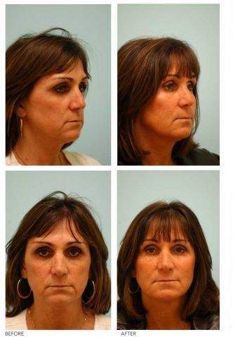 Fat Transfer/Fat Grafting/Facial Rejuvenation