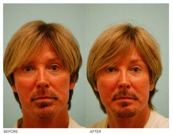 Fat Transfer/Fat Grafting/Facial Rejuvenation