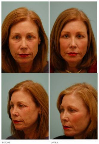 Fat Transfer/Fat Grafting/Facial Rejuvenation