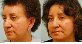 Fat Transfer/Fat Grafting/Facial Rejuvenation
