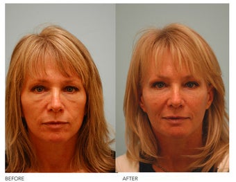 Fat Transfer/Fat Grafting/Facial Rejuvenation