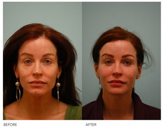Fat Transfer/Fat Grafting/Facial Rejuvenation