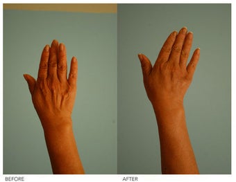 Hand Rejuvenation (with Fat Transfer)