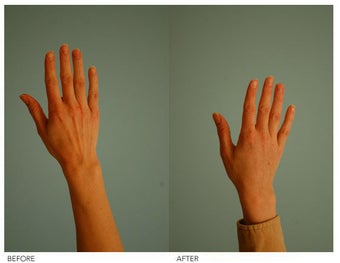 Hand Rejuvenation (with Fat Transfer)
