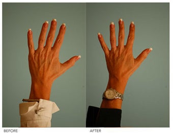 Hand Rejuvenation (with Fat Transfer)
