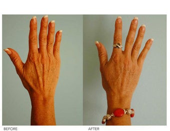 Hand Rejuvenation (with Fat Transfer)