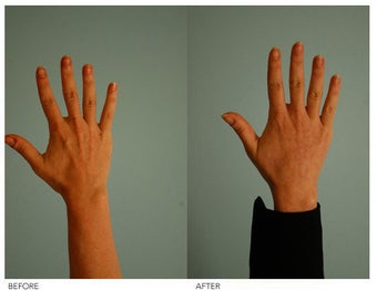 Hand Rejuvenation (with Fat Transfer)