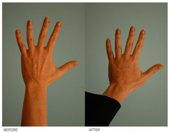 Hand Rejuvenation (with Fat Transfer)