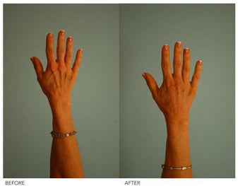 Hand Rejuvenation (with Fat Transfer)