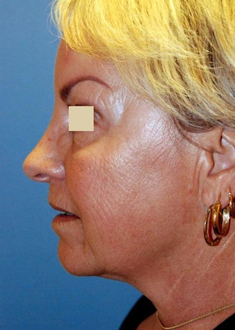 YoungLift ~ Fat Transfer (Full Face)