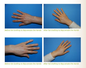 Fat Transfer to the Hands ~ YoungVolumizer Procedure