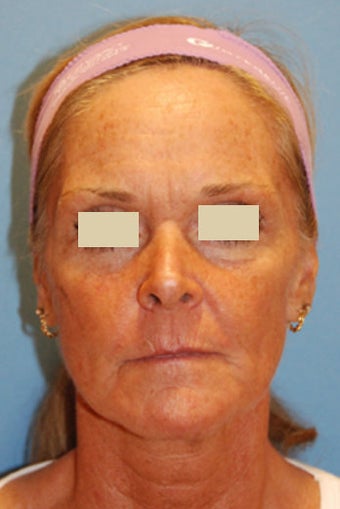 Fat Transfer / Fat Grafting / YoungVolumizer Procedure