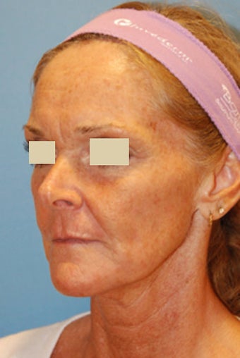 Fat Transfer / Fat Grafting / YoungVolumizer Procedure