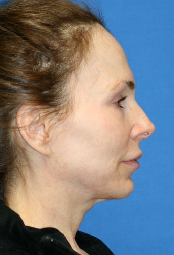 fat transfer