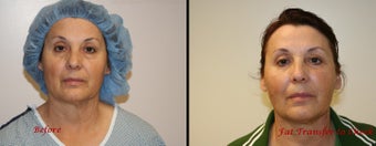 Fat transfer to face