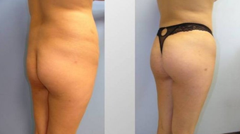 Butt Augmentation (Fat Transfer)