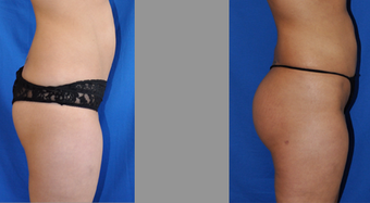 Butt Augmentation (Fat Transfer)
